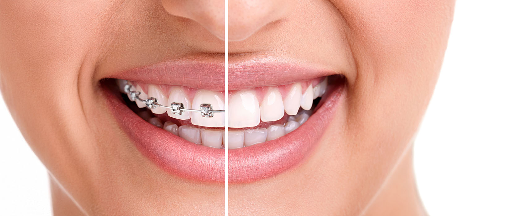 The image shows a smiling woman with straight white teeth, showcasing her smile transformation after orthodontic treatment, with a before-and-after comparison highlighting the improvement.