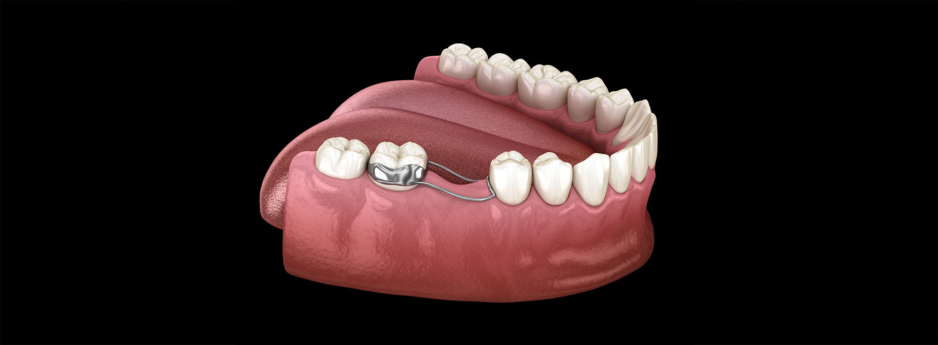 The image shows a close-up of a pink prosthetic mouth with teeth against a dark background.