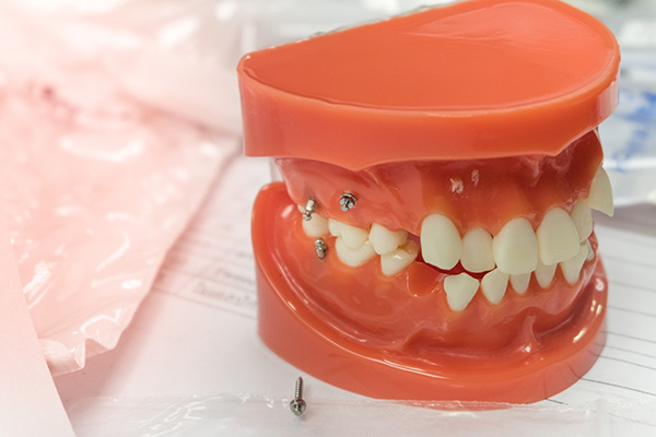 The image displays a red dental mold with teeth shaped like fangs, placed on a white surface, likely for the purpose of creating custom orthodontic appliances or prosthetics.