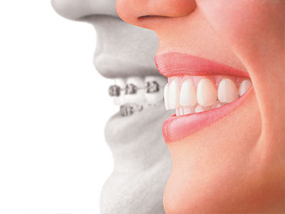 The image shows two split-screen portraits of a person s face with an overlay of a dental implant, emphasizing the transformation from missing teeth to a full smile.