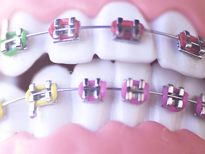 The image shows a close-up view of a person s teeth with braces adorned with colorful bands, against a blurred background.